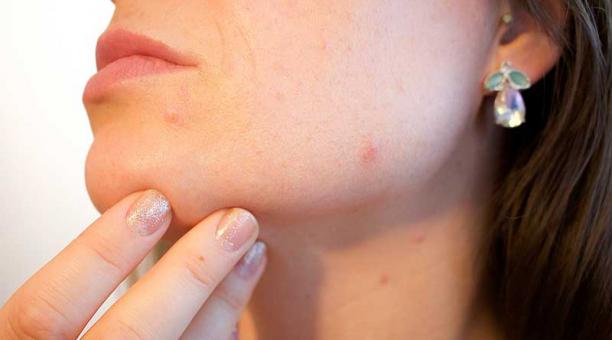 El acné es una de las enfermedades más comunes de la piel. Foto: Pixabay