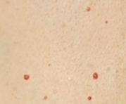 Imagen referencial. Los denominados puntos rojos o puntos rubí aparecen con frecuencia a partir de los 40 ó 45 años. Foto: captura